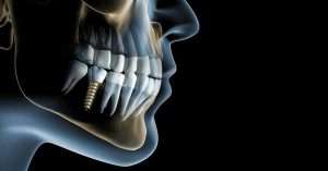 implantes dentales en un dia@1x