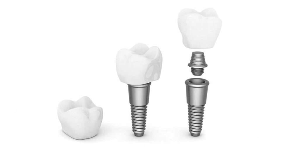 implantes dentales en sevilla