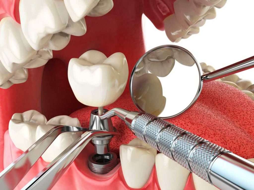 Cómo se coloca un implante dental