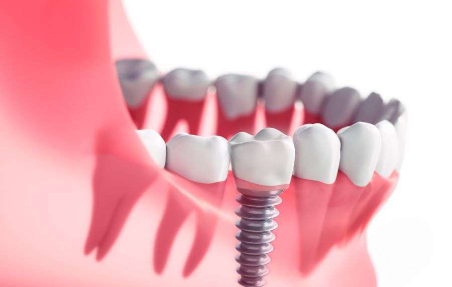 Elige nuestros implantes dentales en viblamed