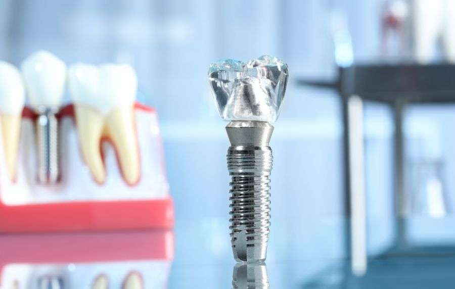 mejores implantes dentales en sevilla