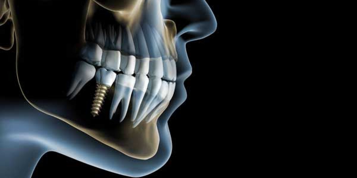 implantes-dentales-en-un-dia@1x