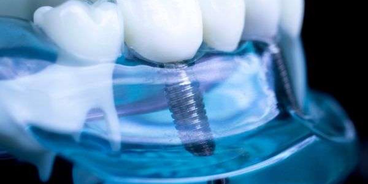 implantes_dentales_carga_inmediata