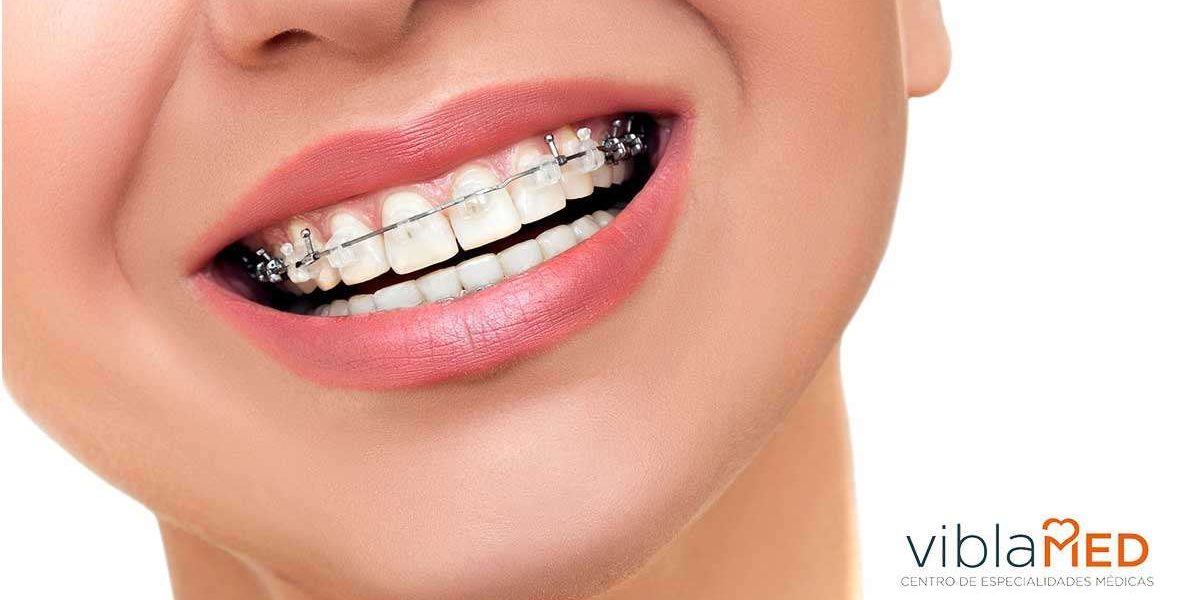 ortodoncia-mover-diente